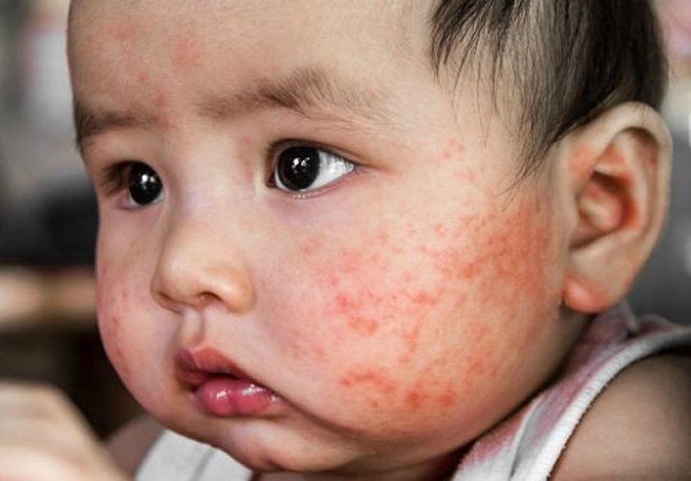 L.reuteri Protectis có thể làm giảm tỷ lệ mắc bệnh chàm liên quan đến IgE ở trẻ sơ sinh.