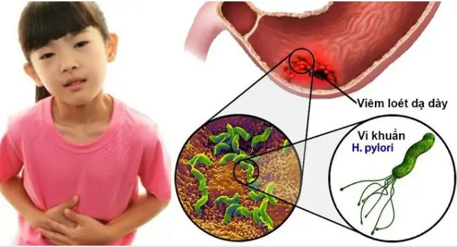 Tác dụng của BioGaia đối với trẻ bị nhiễm Helicobacter pylori